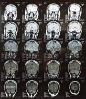 World MS Day 2012: AIIMS to set up database