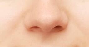 Scientists reconstruct nose from cartilage grown in the lab!