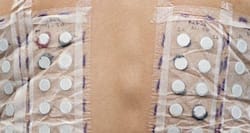 What is the patch test for allergies?