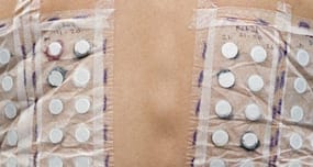 What is the patch test for allergies?