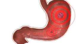 Peptic ulcer -- causes, symptoms, diagnosis, treatment and prevention