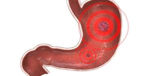 Peptic ulcer -- causes, symptoms, diagnosis, treatment and prevention