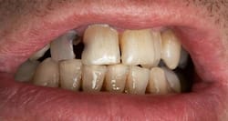 Poor oral hygiene could give you cancer!