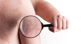 Psoriasis - causes, triggers, symptoms