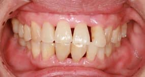 Do you have receding gums?