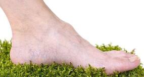 Varicose veins -- could you be at risk?