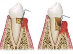 When roots of the teeth are affected by decay