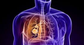 Electronic nose helps locate deadly tumour Electronic nose helps locate deadly tumour