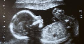 The first ultrasound shows that our baby isn't growing properly (Query)