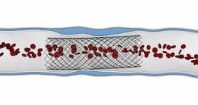 Bioabsorbable stents – the future of angioplasty?