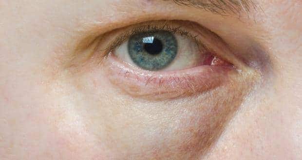 What causes puffy eyes?