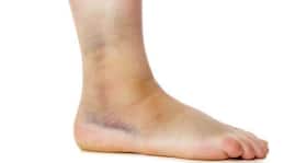 How to treat swollen feet naturally?