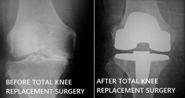 Total Knee Replacement: Common queries answered