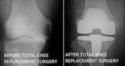 Total Knee Replacement: Common queries answered