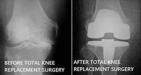 Total Knee Replacement: Common queries answered