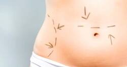 Is the tummy tuck a good option for getting firmer abs?