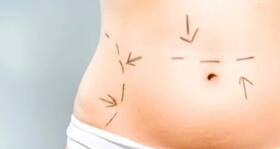Is the tummy tuck a good option for getting firmer abs?