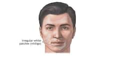 Delhi doc cures Kenyan man's vitiligo