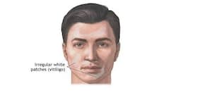 Delhi doc cures Kenyan man's vitiligo