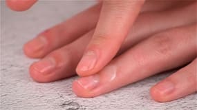 Fingertips Peeling: Know The Causes And Remedies