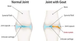 Perform yoga regularly to keep gout at bay