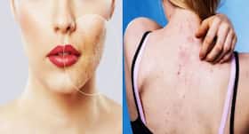 Pimples causes and acne treatments in Hindi