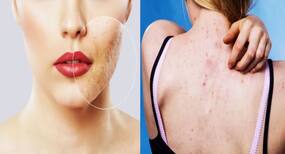 Pimples causes and acne treatments in Hindi