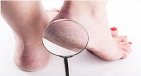 Hiding your cracked heels? Try these simple home remedies to soften your feet