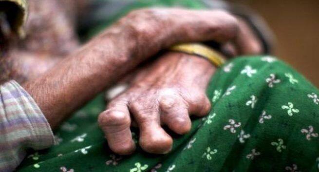 Leprosy Complications