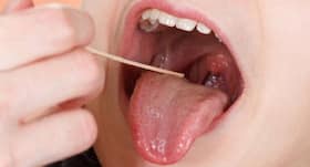Sore Tongue: 5 Effective Home Remedies to Relieve the Pain