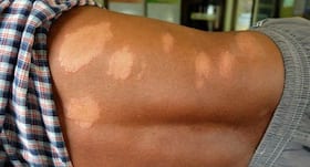 World Leprosy Day 2020: कुष्ठ रोग की पहचान कैसे करें और कुष्ठ रोग ठीक करने के इलाज क्या हैं.?