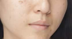 Home remedies: 5 natural herbal extracts to treat acne