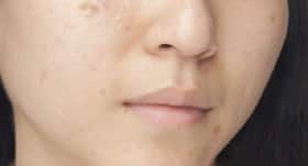 Home remedies: 5 natural herbal extracts to treat acne Home remedies: 5 natural herbal extracts to treat acne