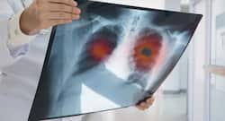 हड्डी का कैंसर होने के कारण, लक्षण, उपचार