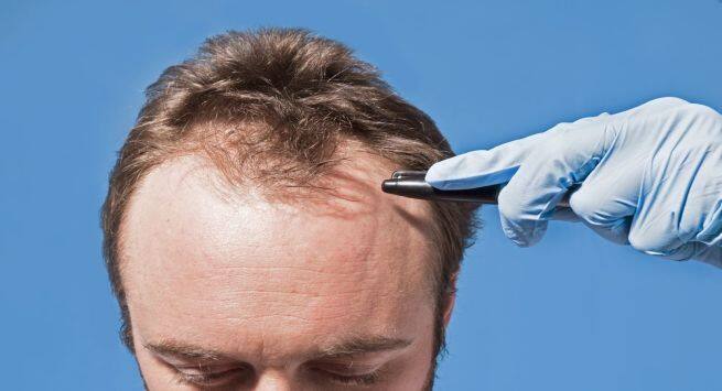 पसओएस म बल कय झडत ह लकषण करण व इलज  PCOS Hair Loss  Symptoms Causes and Treatment in Hindi
