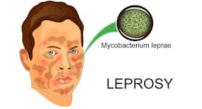 World Leprosy Day 2020: How is this condition diagnosed and treated
