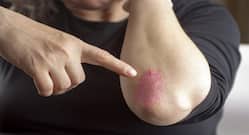 How To Manage Psoriasis In Winter? 5 Dermatologist Tips