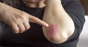 How To Manage Psoriasis In Winter? 5 Dermatologist Tips