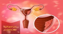 यूटरस कैंसर के शुरुआती लक्षण