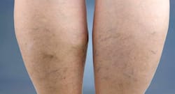 Get relief from varicose veins naturally