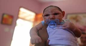 Zika Syndrome : खराब आहार से जुड़ा है जन्मजात जीका सिंड्रोम