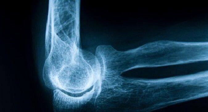 Use of pain reliever tramadol may increase hip fracture risk in adults