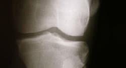 Eat the right foods to make your cartilage more supple