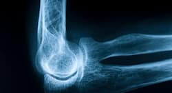 Drug-duo can potentially speed up bone healing process, find scientists