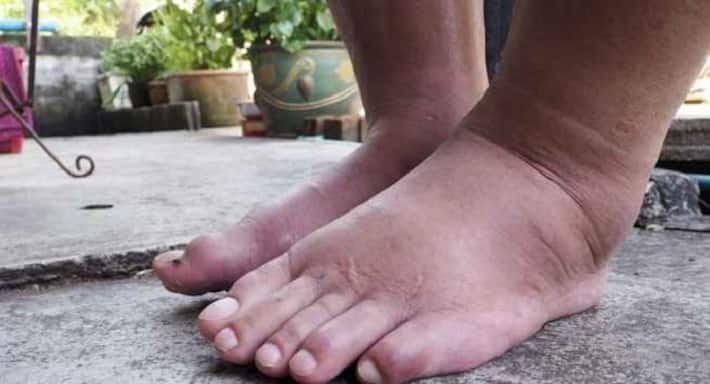 Home remedies to deal with swelling in feet | TheHealthSite.com