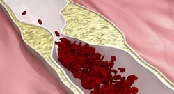 Today health tips: Exercise more and eat healthy to bring down your risk of peripheral artery disease