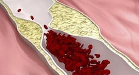 Today health tips: Exercise more and eat healthy to bring down your risk of peripheral artery disease
