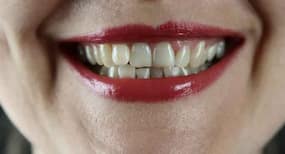 Is the Silent Shield Of Your Teeth Under Attack? Enamel Erosion – Its Causes, Signs and Prevention