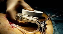 Health Tech: Who needs a cardiac pacemaker?