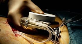 Health Tech: Who needs a cardiac pacemaker?
